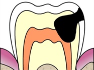 CAMBRA: The New Model for Managing Caries