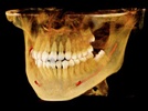 Implant Dentistry: What’s Hot Now and Tomorrow