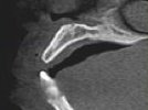 Cone-Beam and 3-D Imaging for Dental Implant Planning: Lessons Learned