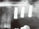 Managing Inadequate Bone in Maxillary Posterior Implant Cases