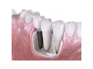 Bone Substitute: The Search for the "Perfect" Grafting Material