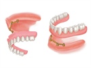 Mini Dental Implants for Denture Stabilization: The Standard of Care