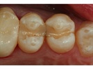 Posterior Direct Composite Case Study