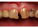 Anterior Direct Composite Case Study