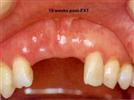 Bone Grafting with Foundation: 2 Case Pictorials