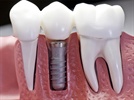 Implant Anchorage in Orthodontics
