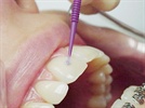 Self-Etch and Total-Etch Bonding: What's the Difference?