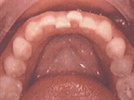 Lower Anterior Crowding - Solving a Common Problem