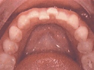 Lower Anterior Crowding - Solving a Common Problem