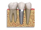 5 Key Technologies Driving Dental Implant Success