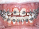 Case Study: Management of Gingival Hypertrophy