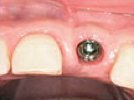 Atraumatic Uncovering of an Implant with Biolase's Waterlase MD All-Tissue Laser