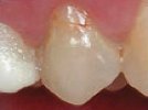 Class V Restoration Case Study: Biolase Waterlase MD for Gingivectomy and Tooth Preparation