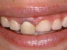 Waterlase MD Case Study: Gingival Recontouring for Smile Line Enhancement