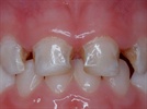 A Case Study with NuSmile Primary Crowns - #1
