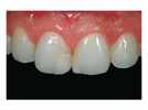Case Study: Repairing Centrals with Shofu Beautifil "Giomer" Restorative