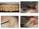 Case Study: Simplified Osseous Crown Lengthening with Biolase's Waterlase MD