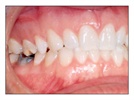 Restorative Case Study: Temrex Bite Relator for Accurate Crown & Bridge Impressions