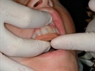 Anterior Bonded Restoration Utilizing A Silicone Matrix: An Esthetic Case Study