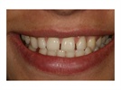 Kerr OptiBond Case Study: Treatment Planning for Function and Aesthetics