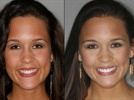 Biolase Waterlase MD Case Study: Better Cosmetic Results, Better Patient Experience