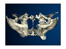 A Case Study Using 3D Imaging for Optimal Implant Treatment Planning