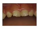 A Case Study with NuSmile Primary Crowns - #3