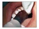 A Case Study with NuSmile Primary Crowns - #2