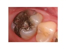 IPS e.max Press Lithium Disilicate Case Study: A Full-Coverage Crown