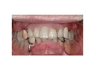 Cadent iTero Digital Impression Case Study: Full-Arch Fixed Provisional Bridge
