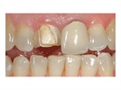 CAD/CAM Case Study: Anterior Porcelain Restorations in a Single Visit