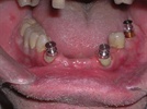 Predictable Implant-Supported Partials: A Resin Record Base Technique