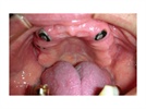 Case Study: Zest Locator Attachments Save an Existing Overdenture