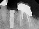 DEXIS Digital Imaging Case Study: Accurate and Simple Implant Placement