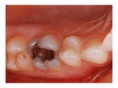 Step-By-Step: Replacing a Worn Posterior Amalgam with IPS Empress Direct