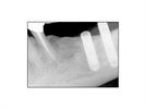 Nobel Biocare Replace Implant Case Study: In with the Old, In with the New