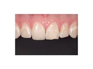 Case Study: Conservative Esthetic Management with Direct Resin Restorations