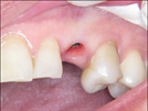 Case Study: 3M ESPE Lava Crowns and Replace Select Implants