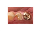 Case Study: Emergency Restoration of Fractured Bicuspid with 3M ESPE Filtek Supreme Plus