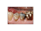 3M ESPE Protemp Crown Case Study: Restoration of Posterior Bicuspid Crown