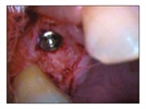 J. Morita Foundation Case Study: Accelerating Bone Growth Prior to Placing Implants