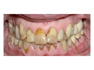 Case Study: Diode-Laser-Assisted 2-Appointment Smile Makeover 