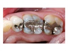 Ivoclar Vivadent Multilink Case Study: Cementation of Esthetic CAD/CAM Crowns