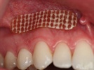 DentiPatch