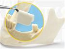 Zimmer CurV Pre-Shaped Collagen Membrane: Breaking Free From Titanium Mesh