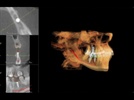 Product Overview:  i-CAT for Implants