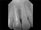 Using CEREC To Surpass Expectations For A Patient