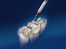 Product Overview: X-tra Base Bulk Fill Posterior Composite