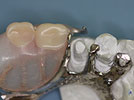 Using CEREC For A Crown Under A Partial Denture