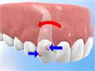 Video: Invisalign G4 3D Treatment Planning Software